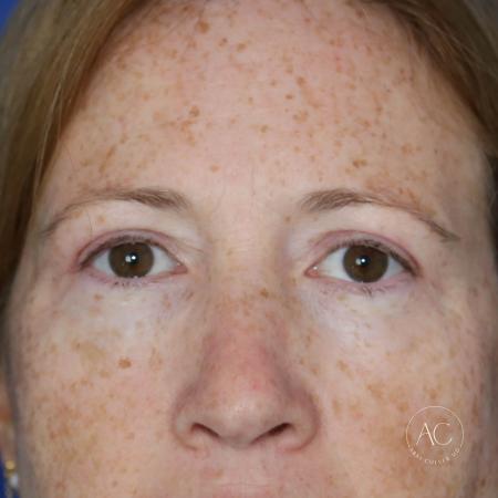 After image 1 Case #127901 - Upper blepharoplasty