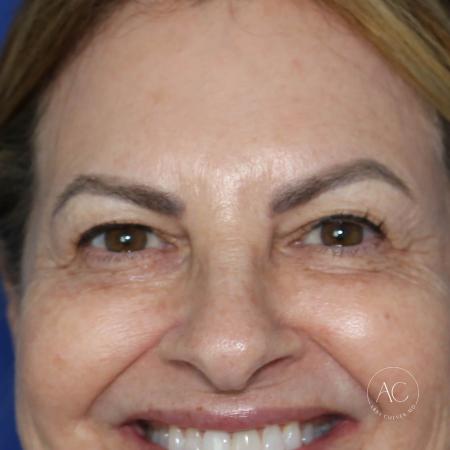 Before image 1 Case #128226 - Upper blepharoplasty and brow lift
