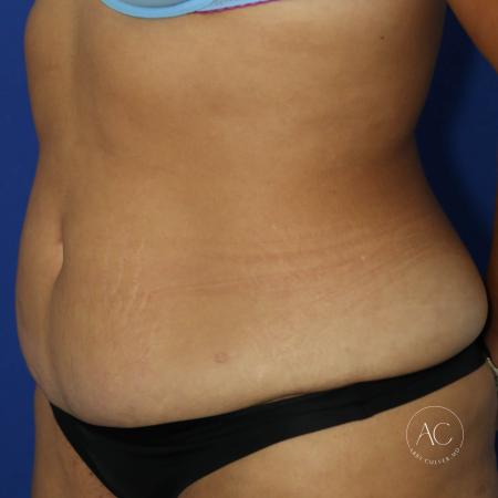 Before image 2 Case #128071 - Circumferential trunk lipo/extended abdominoplasty