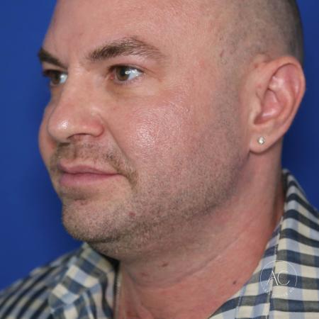 Before image 2 Case #128221 - Upper bleph, buccal fat reduction, submental lipo