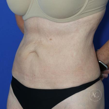 Before image 2 Case #128061 - Abdominoplasty
