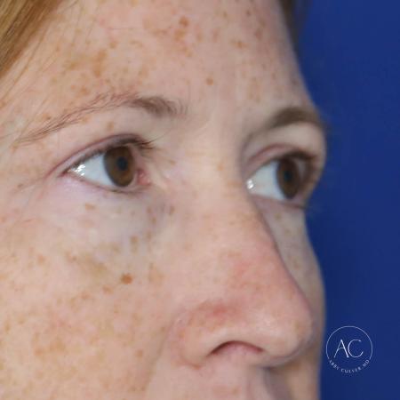 After image 3 Case #127901 - Upper blepharoplasty