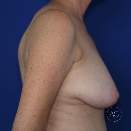 Before image 3 Case #127946 - Breast reduction and scar revision