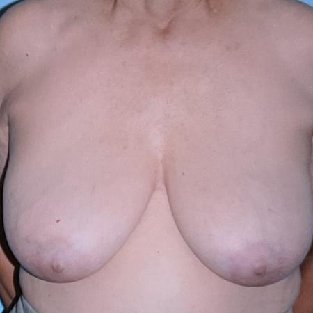 Before image 1 Case #128276 - Breast Lifting after sixties!