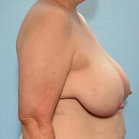 Before image 3 Case #128286 - Breast Lifting 