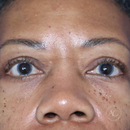 After image 1 Case #127921 - Upper blepharoplasty
