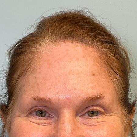 Before image 2 Case #127936 - 56 y.o. female with Botox 