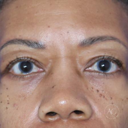 Before image 1 Case #127921 - Upper blepharoplasty
