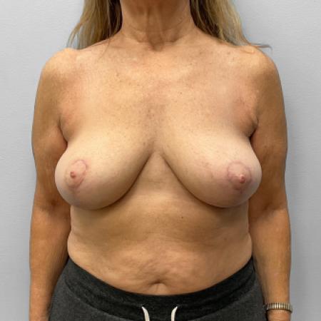 After image 1 Case #127706 - Breast Lift & Implant Removal