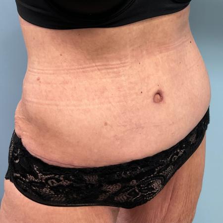 After image 2 Case #127556 - Tummy Tuck + Lipo of Flanks/Thighs + Bra Line Lift