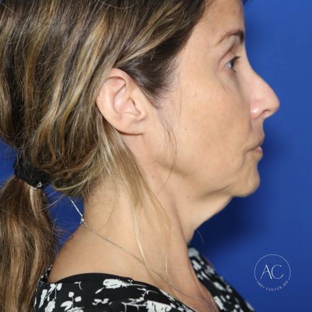 Before image 3 Case #128201 - Deep plane facelift, necklift, upper/lower bleph