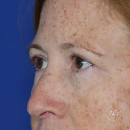 After image 2 Case #127901 - Upper blepharoplasty