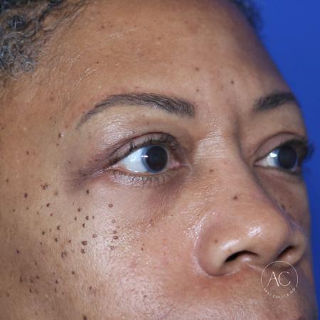 Before image 2 Case #127921 - Upper blepharoplasty