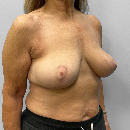 After image 2 Case #127706 - Breast Lift & Implant Removal