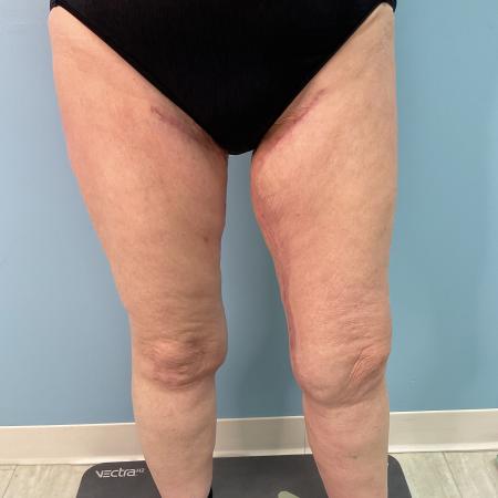 After image 2 Case #128241 - 66 y.o. female w/ Thigh Lift & Lipo Thighs & Calf