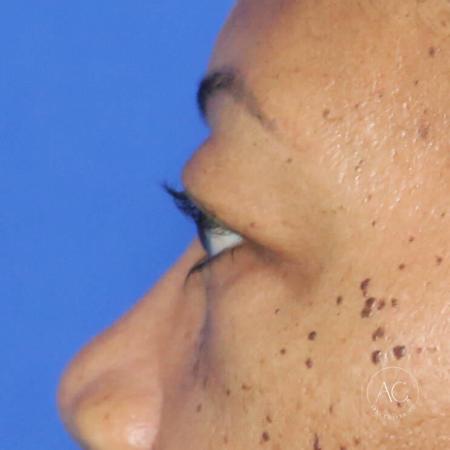 Before image 3 Case #127921 - Upper blepharoplasty