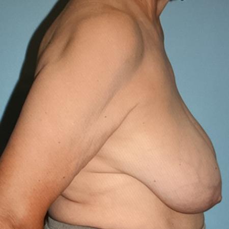 Before image 3 Case #128276 - Breast Lifting after sixties!