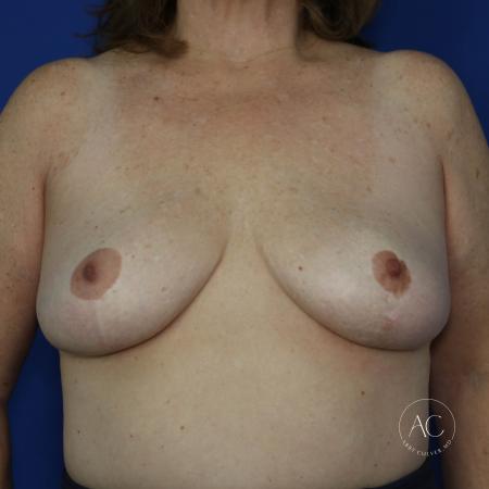 After image 1 Case #128066 - Lateral chest lift
