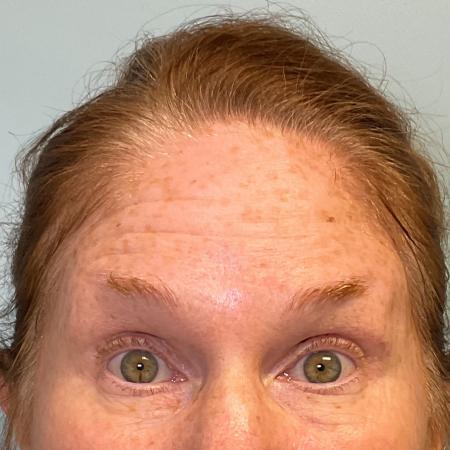 Before image 1 Case #127936 - 56 y.o. female with Botox 