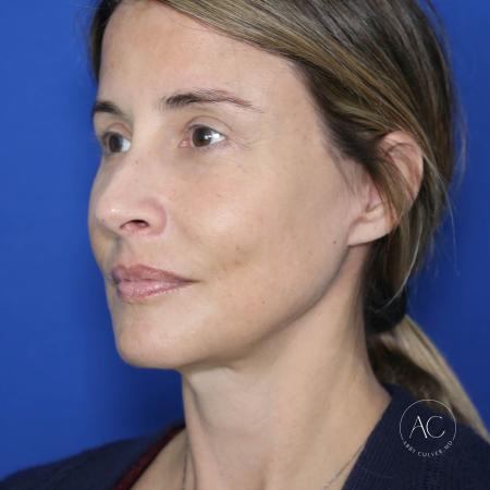 After image 2 Case #128201 - Deep plane facelift, necklift, upper/lower bleph