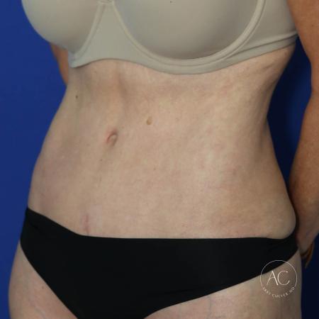After image 2 Case #128061 - Abdominoplasty
