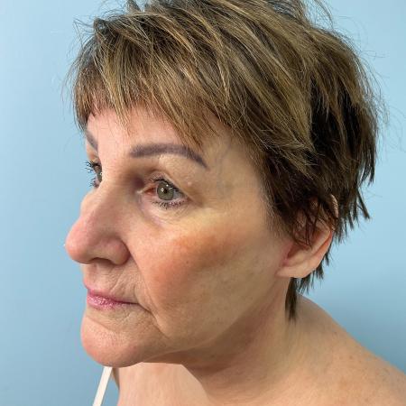 After image 2 Case #127961 - 69 y.o. w/ Face & Neck Lift, MyEllevate & Renuvion