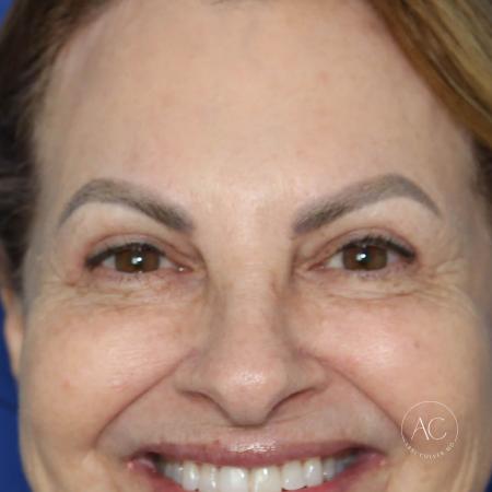 After image 1 Case #128226 - Upper blepharoplasty and brow lift