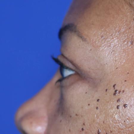 After image 3 Case #127921 - Upper blepharoplasty