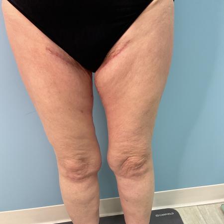 After image 1 Case #128241 - 66 y.o. female w/ Thigh Lift & Lipo Thighs & Calf