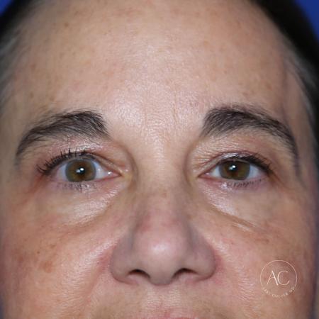 Before image 1 Case #127906 - Upper blepharoplasty