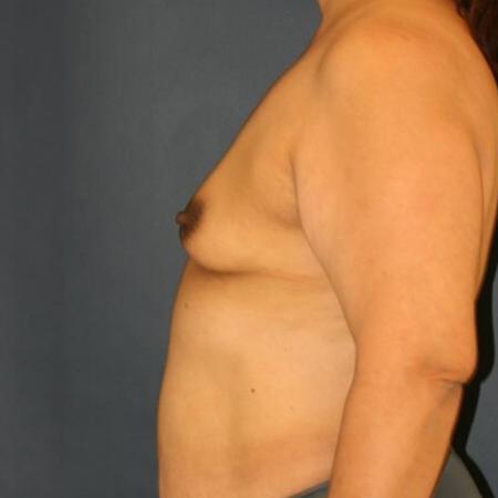 Before image 2 Case #127621 - Breast Augmentation
