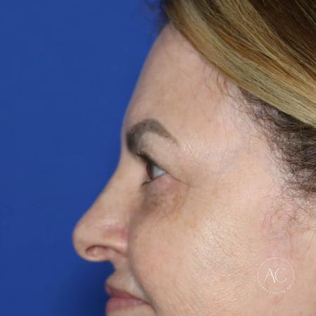 Before image 3 Case #128226 - Upper blepharoplasty and brow lift