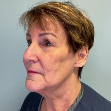 Before image 2 Case #127961 - 69 y.o. w/ Face & Neck Lift, MyEllevate & Renuvion
