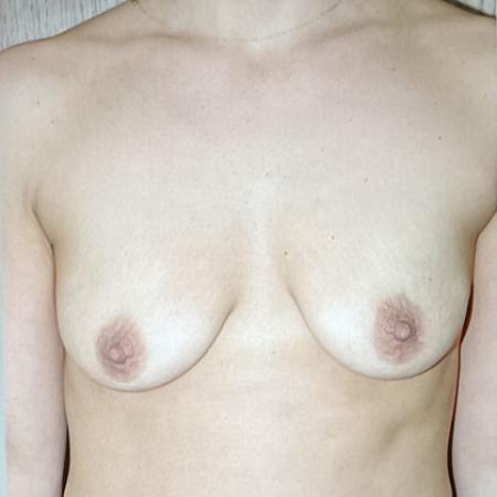 Before image 1 Case #128281 - Breast Lifting 