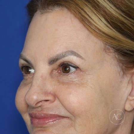 After image 2 Case #128226 - Upper blepharoplasty and brow lift