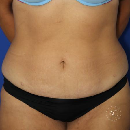 Before image 1 Case #128071 - Circumferential trunk lipo/extended abdominoplasty