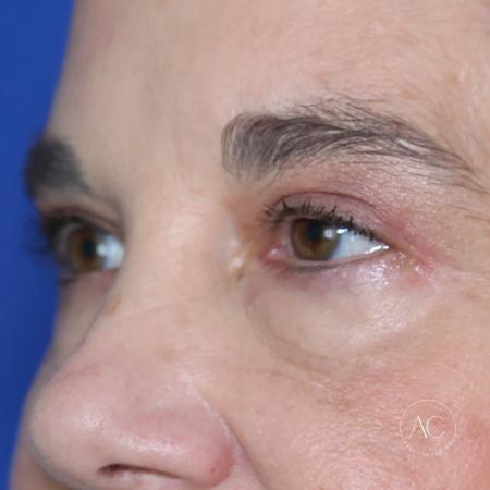 After image 2 Case #127906 - Upper blepharoplasty