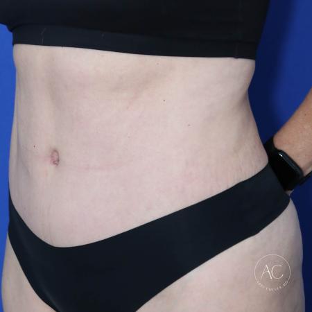 After image 2 Case #128771 - Abdominoplasty
