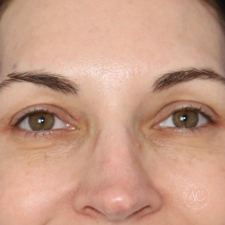 Before image 1 Case #128766 - Upper blepharoplasty