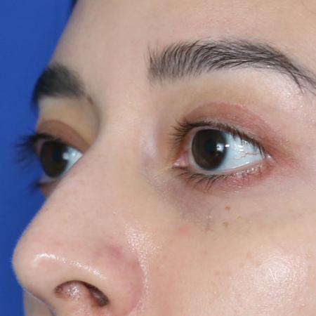 After image 2 Case #128821 - Upper blepharoplasty
