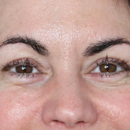 Before image 1 Case #128786 - Upper blepharoplasty
