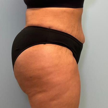 After image 2 Case #128716 - 50 y.o female with Tummy Tuck, BBL, & Lipo