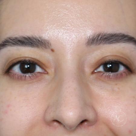 Before image 1 Case #128821 - Upper blepharoplasty