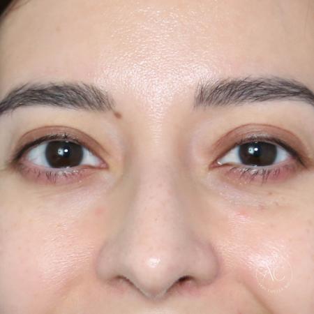 After image 1 Case #128821 - Upper blepharoplasty