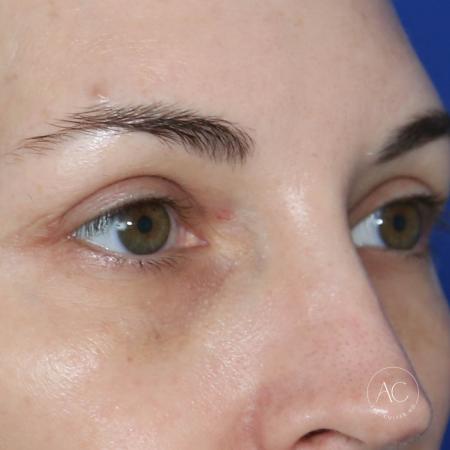 After image 2 Case #128766 - Upper blepharoplasty