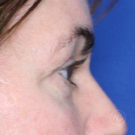 Before image 3 Case #128786 - Upper blepharoplasty