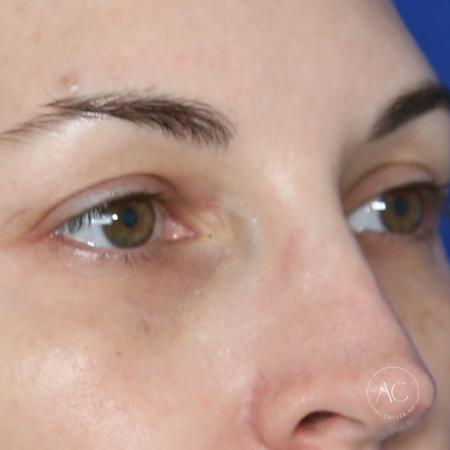 Before image 2 Case #128766 - Upper blepharoplasty