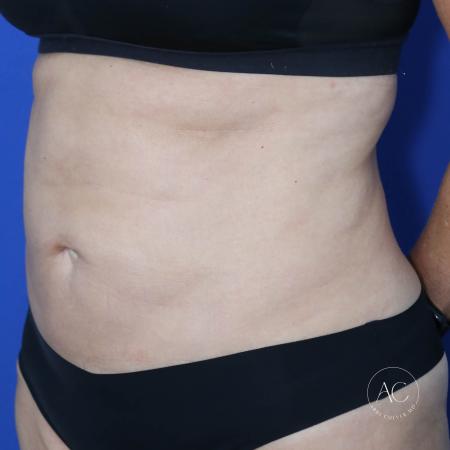 Before image 2 Case #128771 - Abdominoplasty