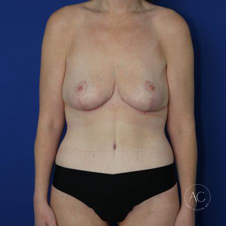 After image 1 Case #128776 - Breast reduction and abdominoplasty
