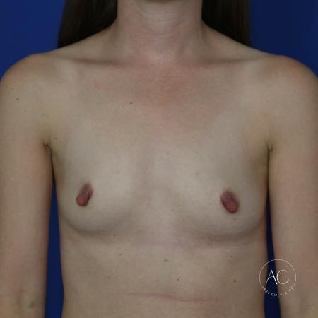 Before image 1 Case #128791 - Breast augmentation
